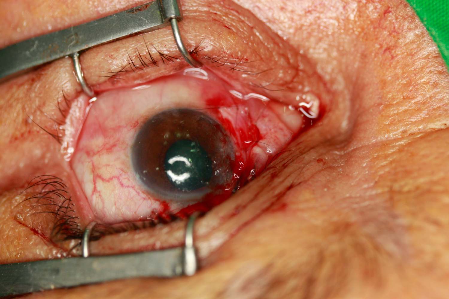 ลอกต้อเนื้อ