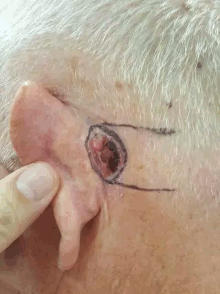 ก้อนเนื้อที่หลังหู