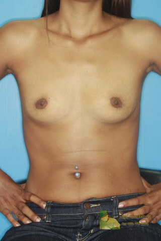 ก่อนเสริมหน้าอก