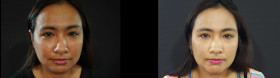 ก่อนและหลังเสริมคางด้วยซิลิโคน