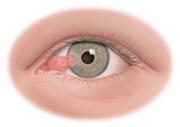 pterygium