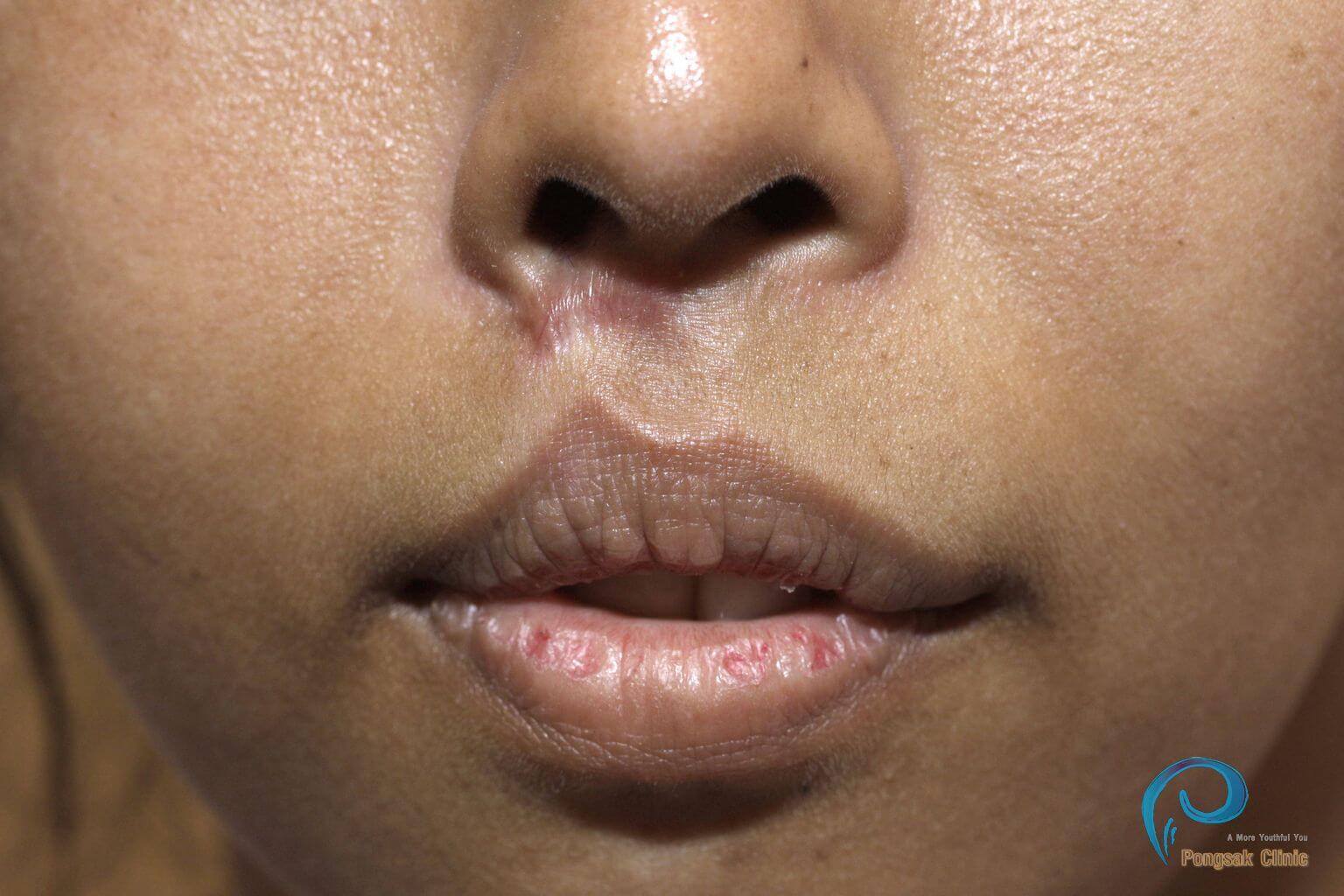 Philtrum Scar Revision (Post Cleft-Lip Repair) — after