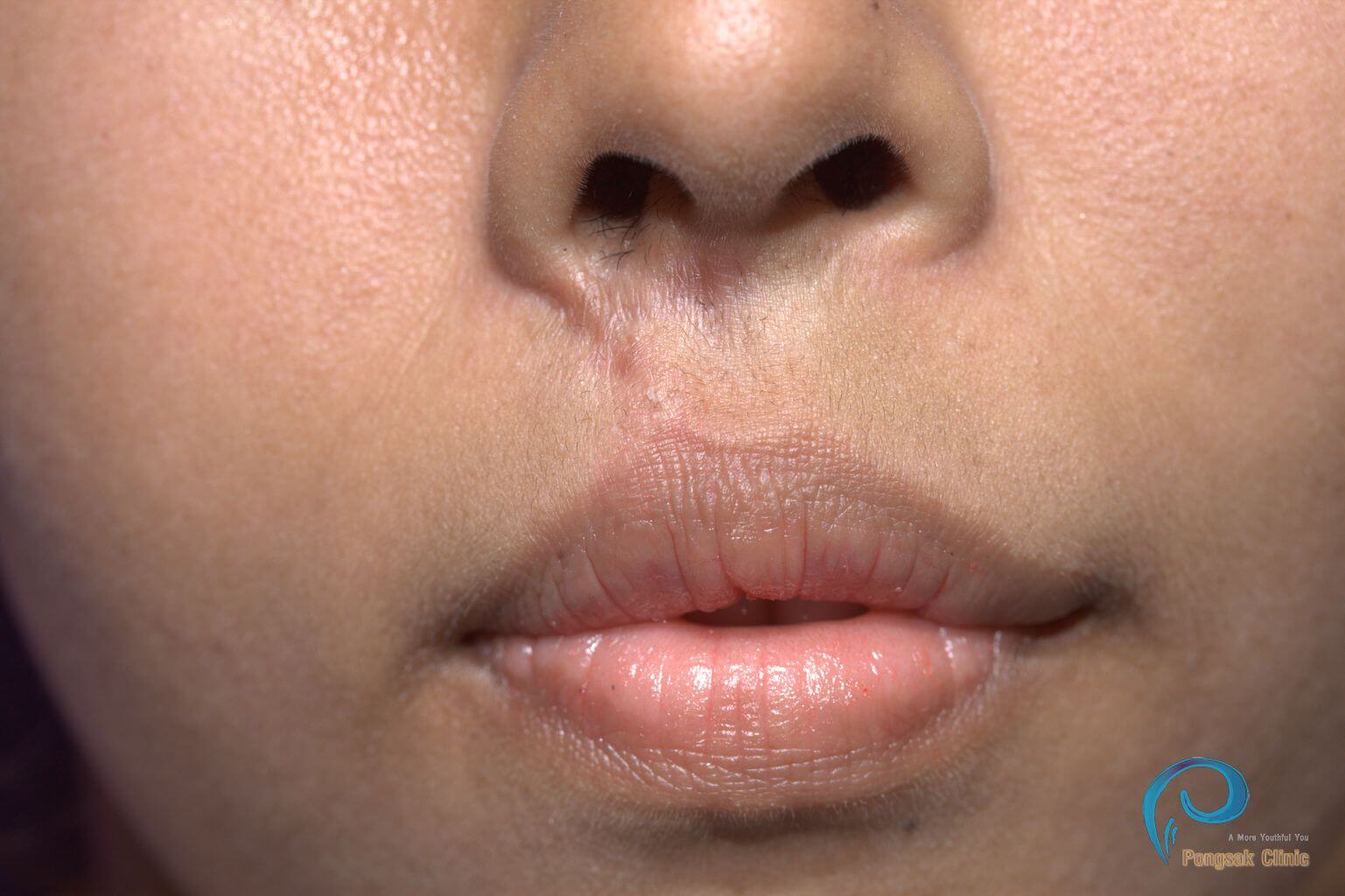 Philtrum Scar Revision (Post Cleft-Lip Repair) — before