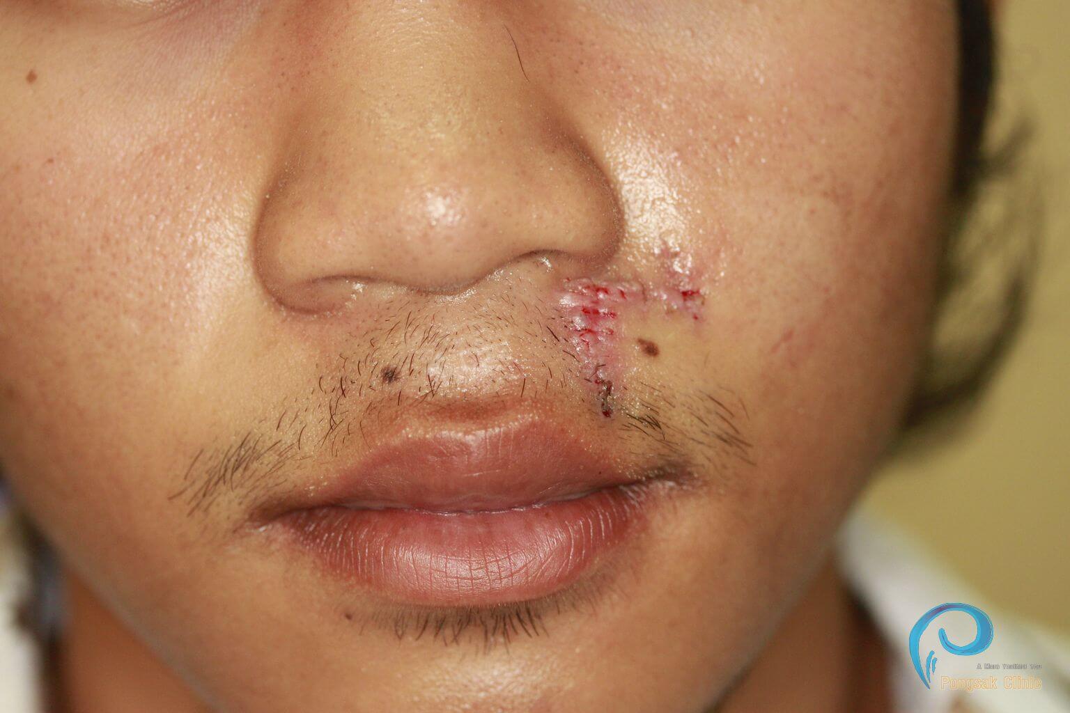 Perioral Lesion Excision — after