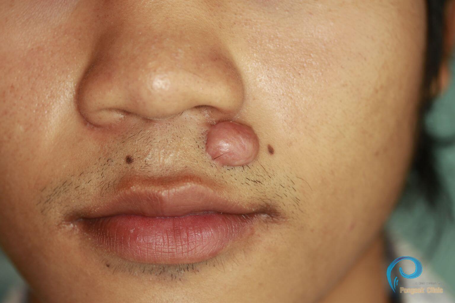 Perioral Lesion Excision — before