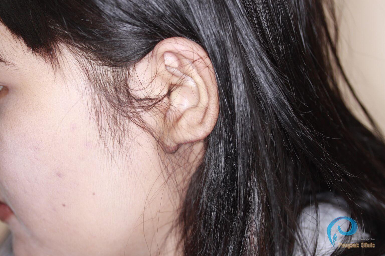 Ear Keloid Excision (Post-Piercing) — after