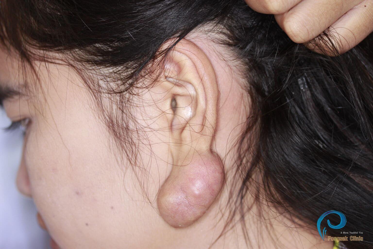 Ear Keloid Excision (Post-Piercing) — before
