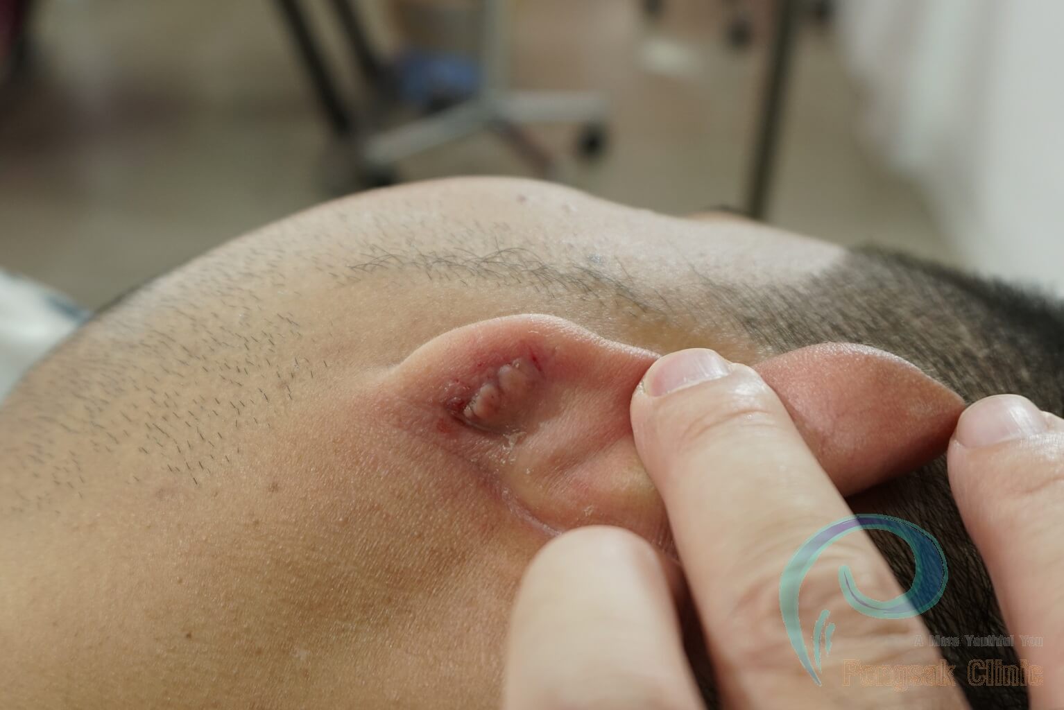 Ear Lobule Keloid Excision (Post-Piercing) — after