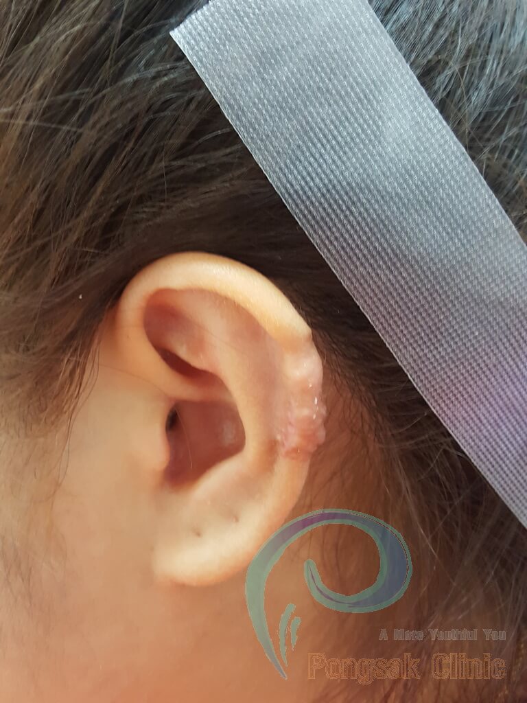 Helical Rim Keloid Excision (Upper Helix) — after