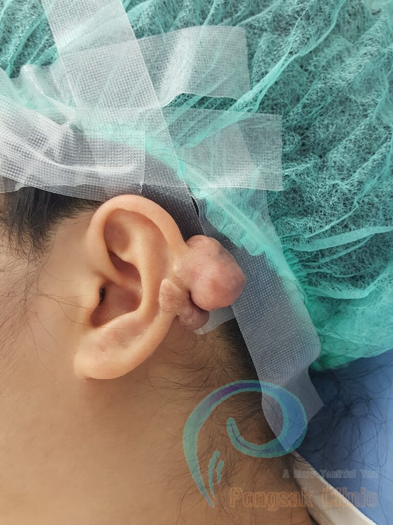 Helical Rim Keloid Excision (Upper Helix) — before