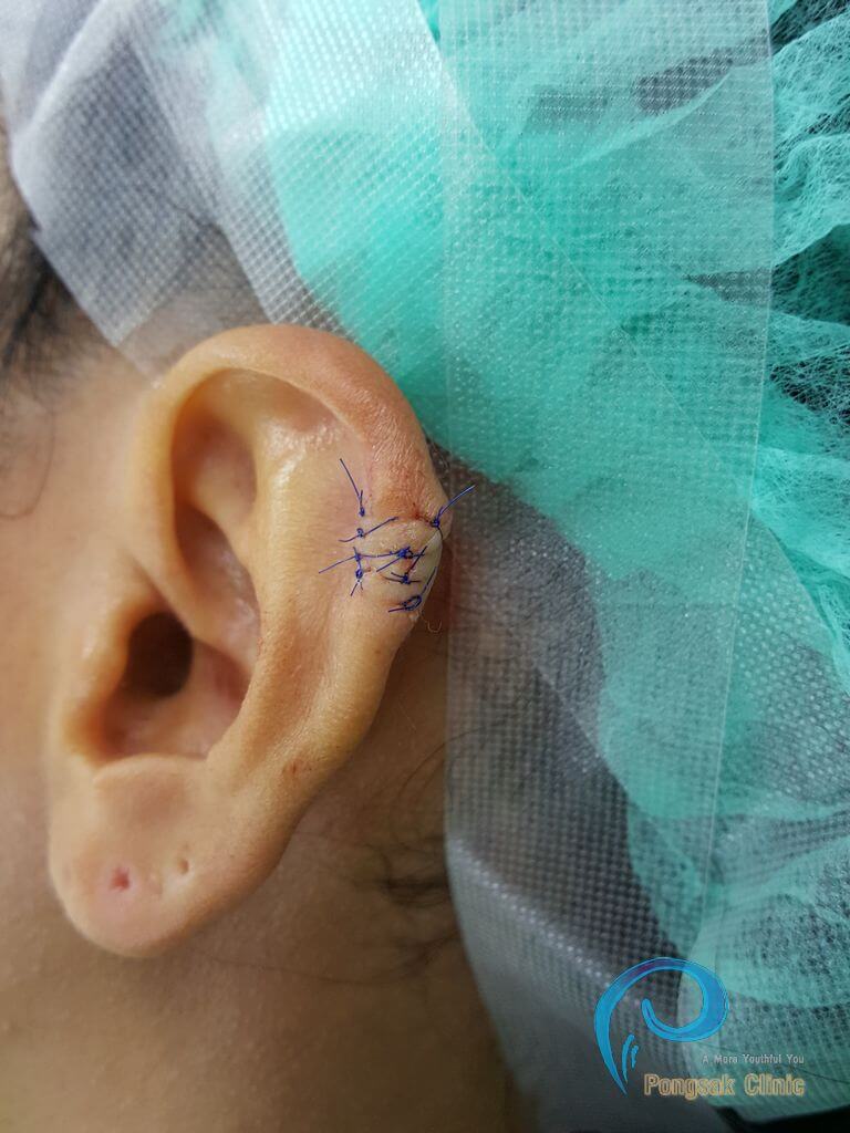 Helical Keloid Excision (Surgical Step Visible) — after