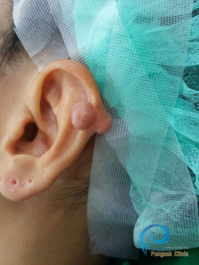 Helical Keloid Excision (Surgical Step Visible) — before