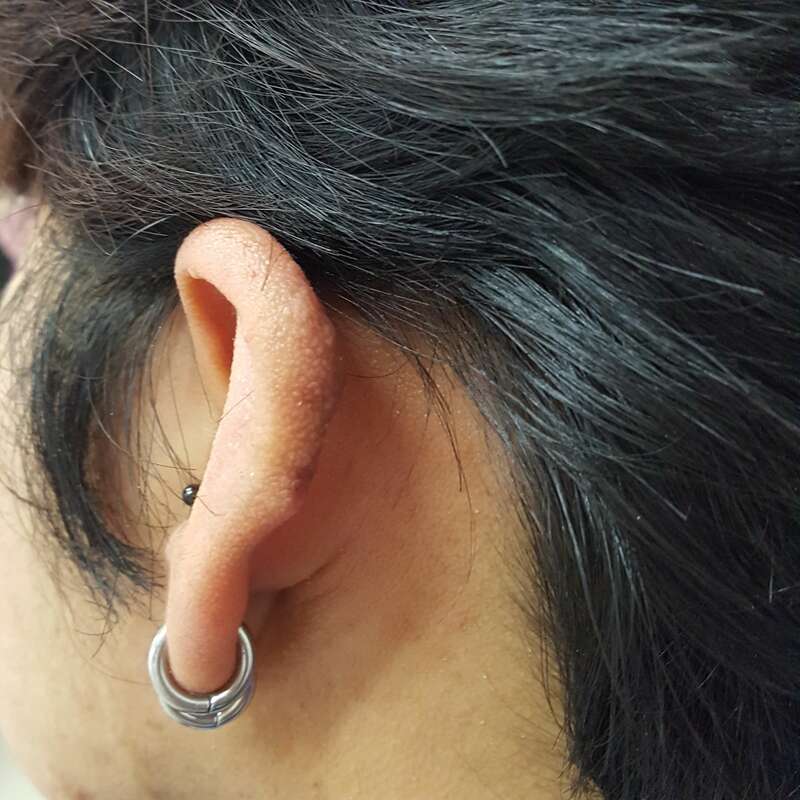 Extensive Auricular Keloid — Surface Resurfacing & Contour Restoration — after