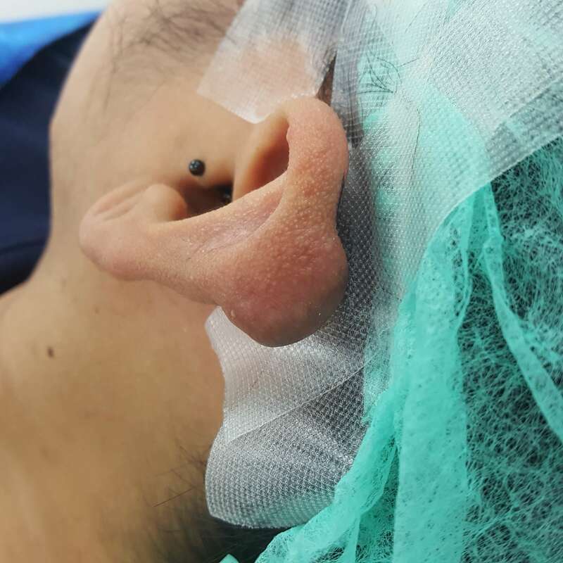 Extensive Auricular Keloid — Surface Resurfacing & Contour Restoration — before