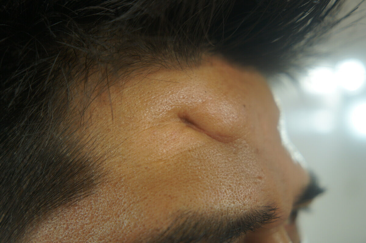Forehead Depressed Scar Revision (Post-Trauma) — after