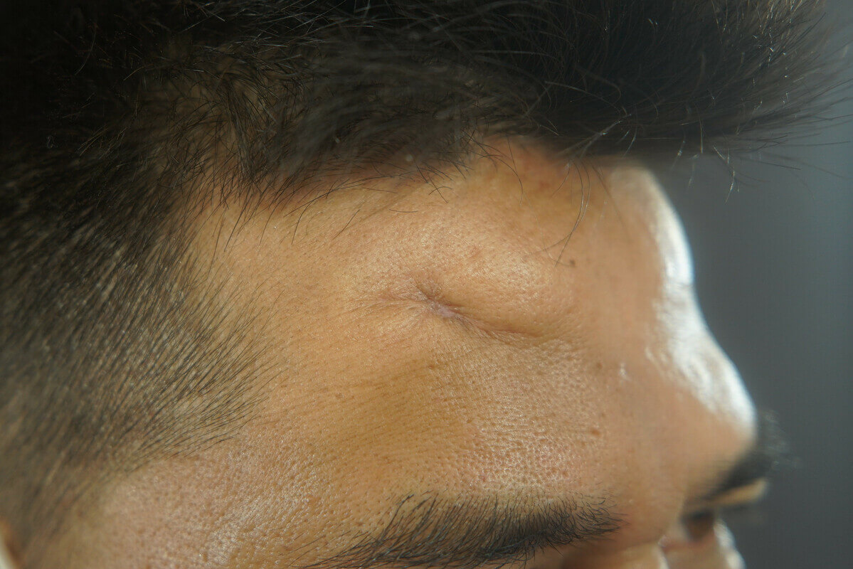 Forehead Depressed Scar Revision (Post-Trauma) — after