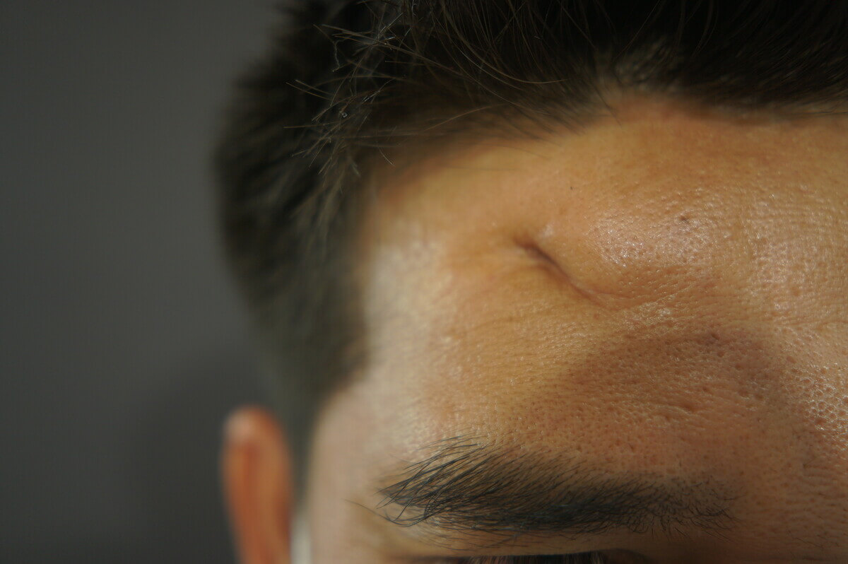 Forehead Depressed Scar Revision (Post-Trauma) — before