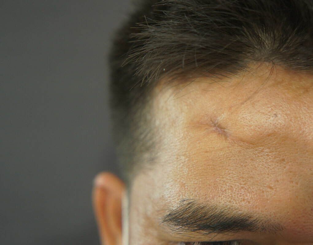Forehead Depressed Scar Revision (Post-Trauma) — before