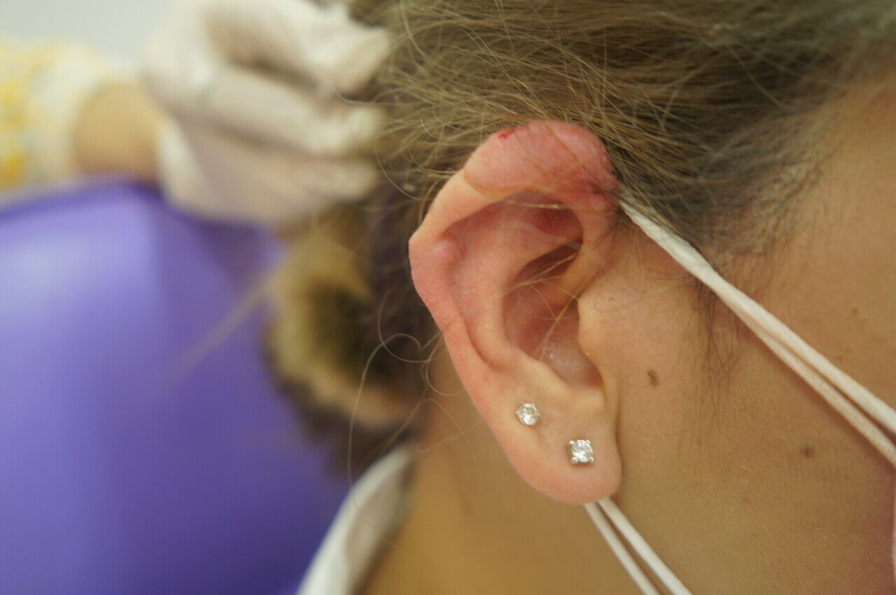 Helical Keloid Excision (Healed Result) — after