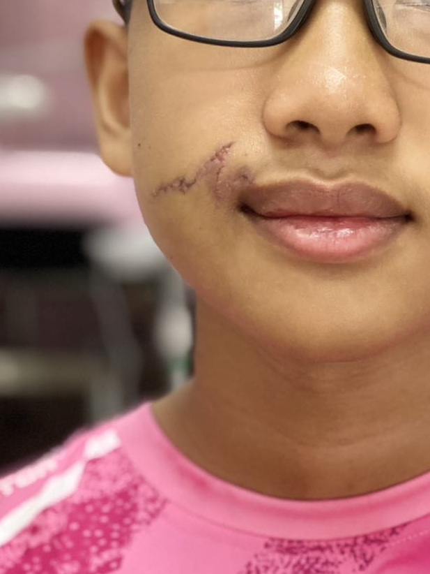 แก้ไขแผลเป็นด้วยเทคนิค Z-plasty (แก้มถึงริมฝีปากบน, จากการบาดเจ็บ) — after