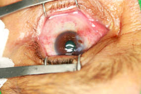 Pterygium excision with graft